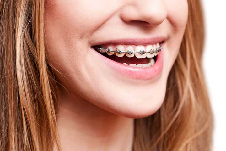 Student with braces treated by best dentist in delhi